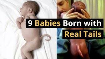 'Video thumbnail for 9 Babies Reported with Real Tails - Science Behind the Occurrence of Human Tails - Health & Science'