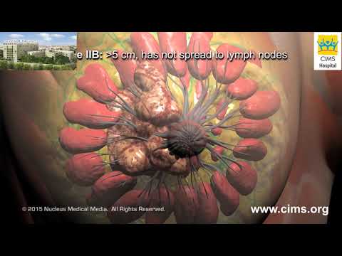 Breast Cancer Progression and Staging – CIMS Hospital