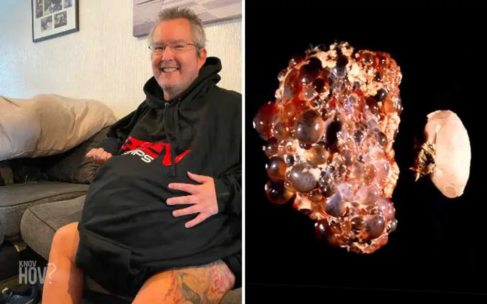 Warren Higgs, with Record-breaking Kidneys, Grew up to an Estimated 40kg due to Polycystic Kidney Disease