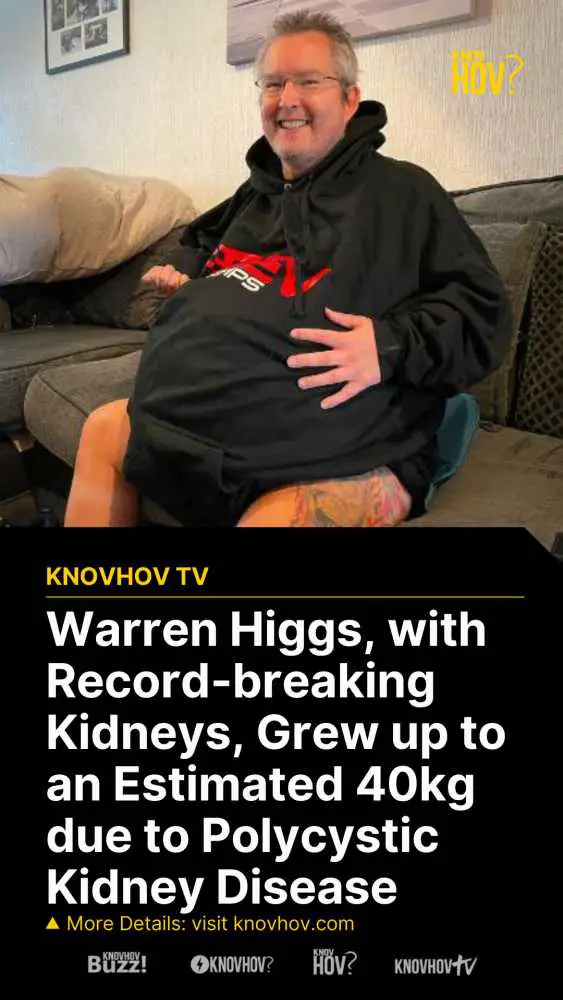 Warren Higgs, with Record-breaking Kidneys, Grew up to an Estimated 40kg due to Polycystic Kidney Disease