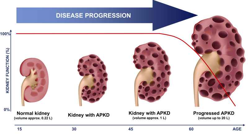 Warren Higgs, with Record-breaking Kidneys, Grew up to an Estimated 40kg due to Polycystic Kidney Disease