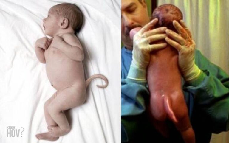 Science behind the Babies that were Born with Real Tails (9 Baby Tail Reports)