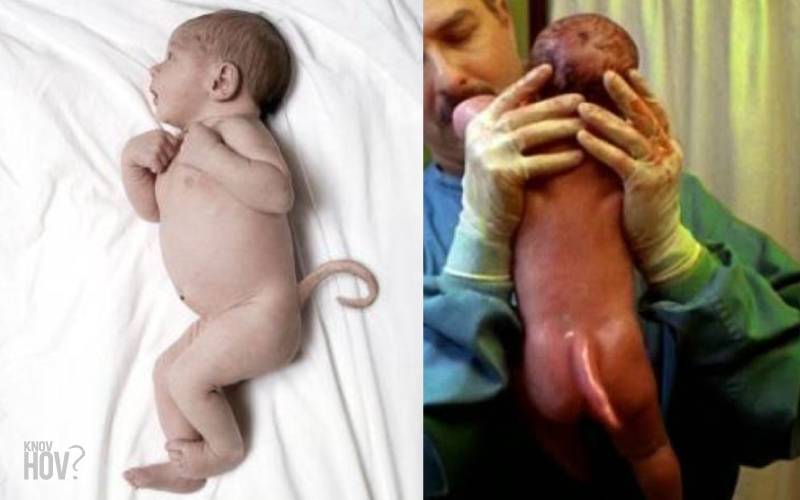 Discover the Science behind the Babies that were Born with Real Tails