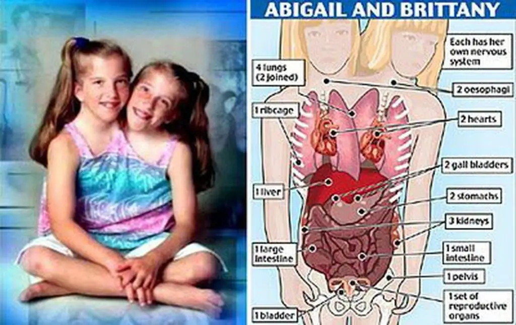 The anatomy of conjoined twins, Brittany and Abby Hensel.