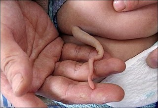 Discover the Science behind the Babies that were Born with Real Tails