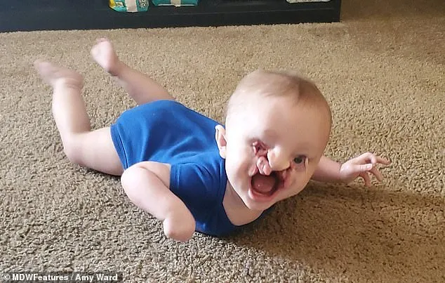 Amy Ward, who is 24 years old and lives in Illinois, had her son Elijah on January 31, 2020. He was born with a rare condition called amniotic band syndrome. This happens when the fluid sac that surrounds the baby during pregnancy breaks, causing amniotic bands to wrap around the child.