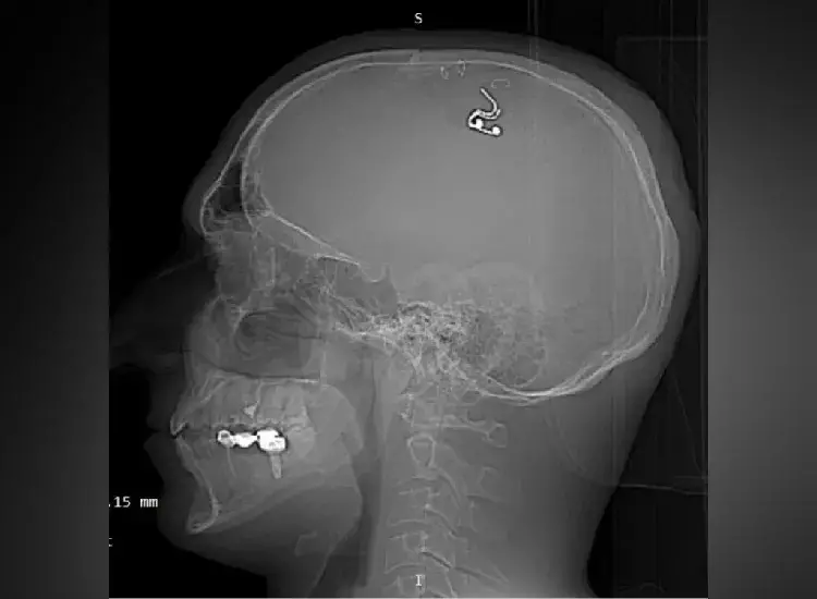 Explore the controversial story of a Russian man who drilled into his skull to implant a microchip, aiming to unlock dream control technologies.