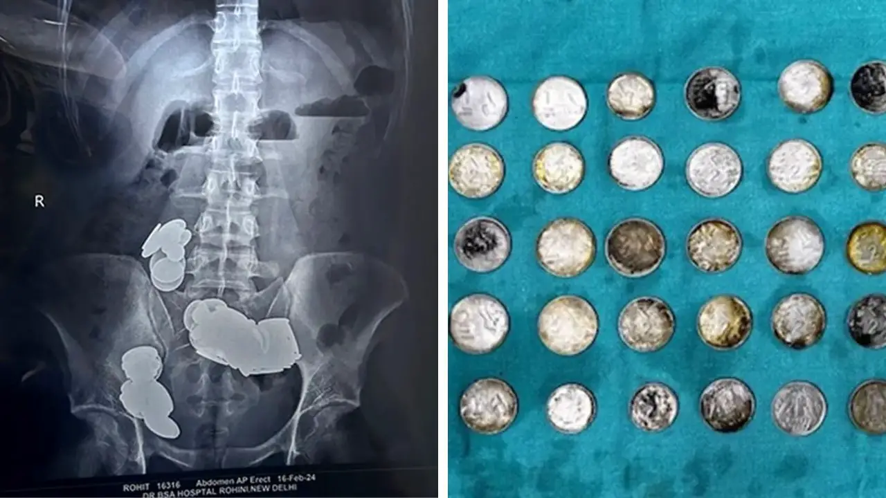 Indian Man Consumes 39 Coins, 37 Magnets in Belief of Zinc's Bodybuilding Benefits