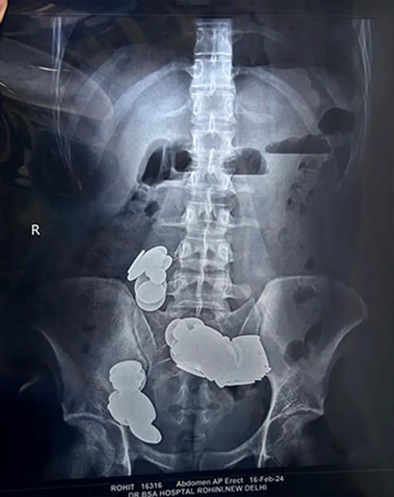 Indian man swallows 39 coins and 37 magnets believing zinc boosts bodybuilding benefits. Read about the bizarre case and life-saving surgery at Sir Ganga Ram Hospital.