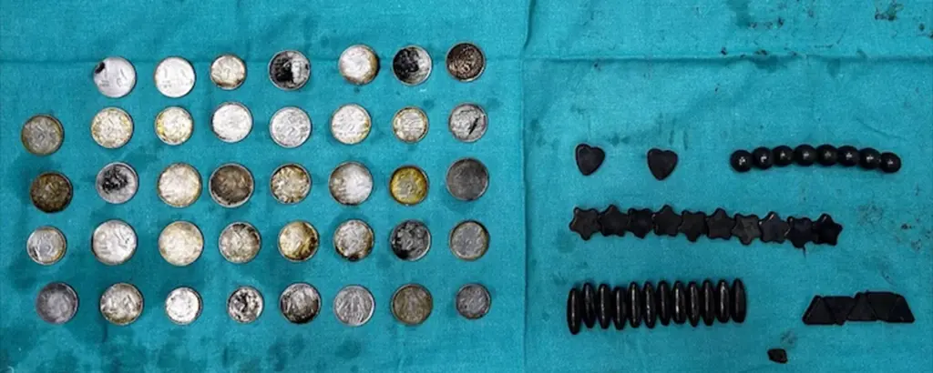 🔥Unbelievable! Indian Man Swallows 39 Coins & 37 Magnets for Zinc's Muscle Power! Discover the Jaw-Dropping Story Now! #IncredibleIndia 🇮🇳