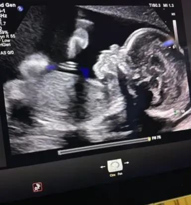 Georgia abortion law keeps brain-dead pregnant woman on life support, family calls it 'torture' Adriana’s tragic journey began in early February 2025 when, at nine weeks pregnant, she started experiencing severe headaches.