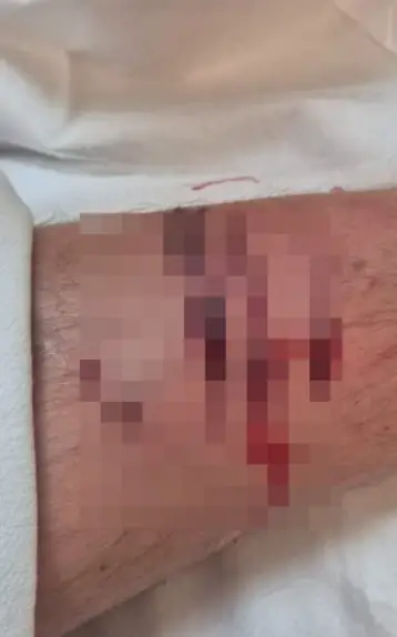 27-year-old mauled by ferocious hyenas after being dragged from tent while sleeping off booze at Cape Vidal. Shocking wildlife attack leaves farmer with 70 stitches. Read the harrowing tale.